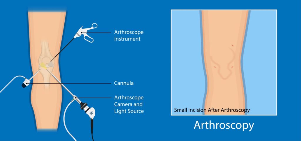 Advanced surgical procedures had made previously long. invasive surgeries like arthroscopy routine, and with high success rates. Advanced surgical procedures had made previously long. invasive surgeries like arthroscopy routine, and with high success rates.